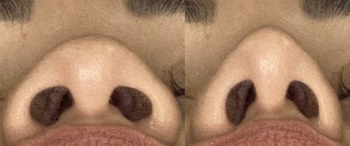 Rinoplastia — vista inferior antes e depois