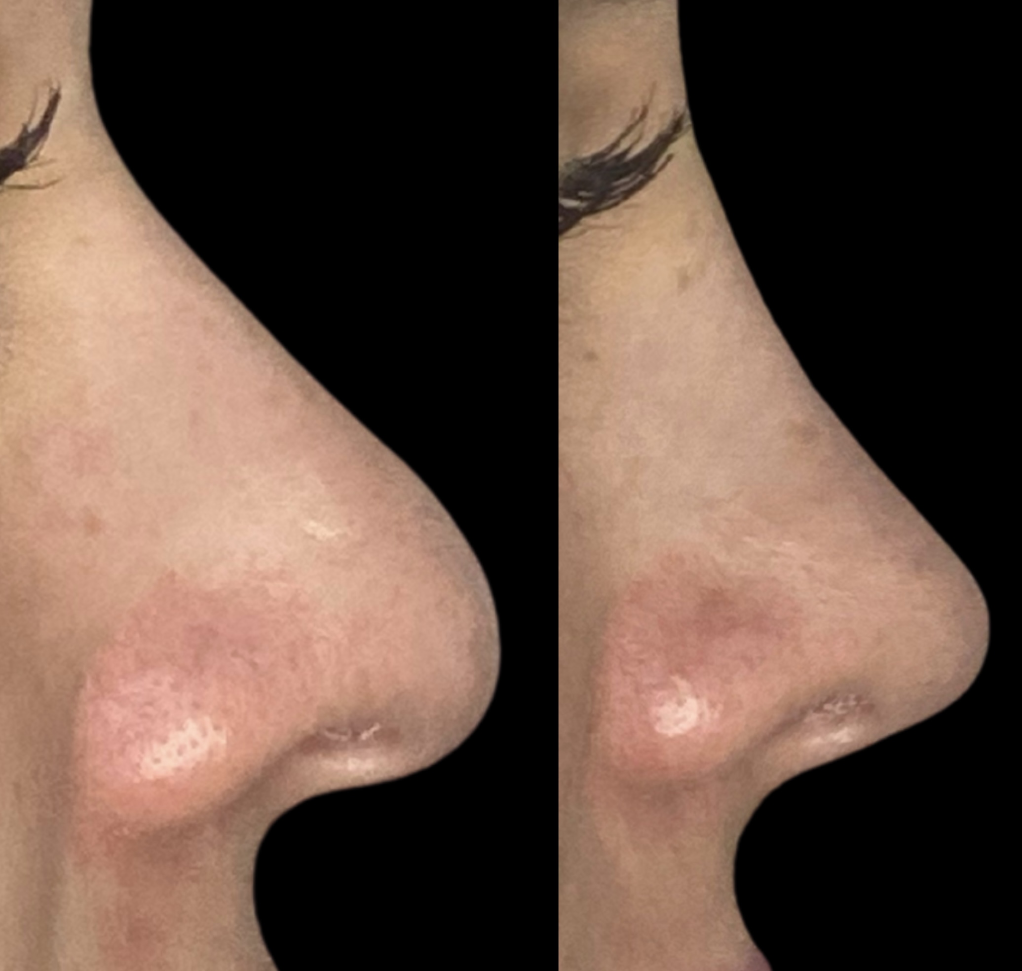 Rinoplastia — perfil antes e depois